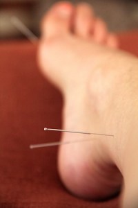 acupuncture-1
